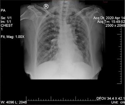 Coinfection With SARS-CoV-2 and Dengue Virus: A Case Report Highlighting Diagnostic Challenges